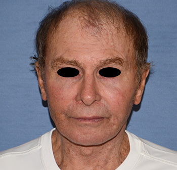 Facelift Facelift