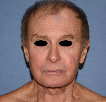 Facelift Facelift