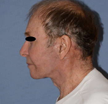 Facelift Facelift