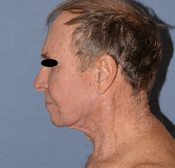 Facelift Facelift