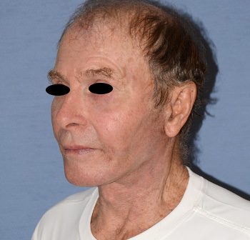 Facelift Facelift