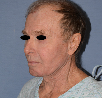 Facelift Facelift
