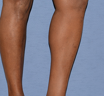 Calf Augmentation Implants Calf Augmentation Implants