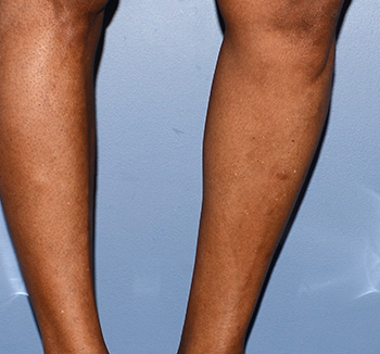 Calf Augmentation Implants Calf Augmentation Implants