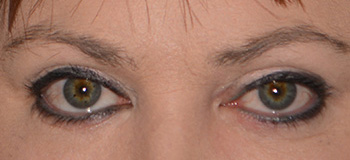 bleharoplasty eyelid lift bleharoplasty eyelid lift