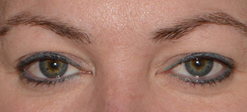 bleharoplasty eyelid lift