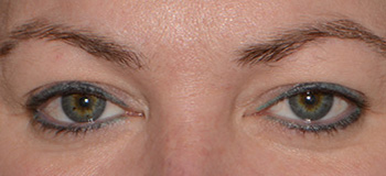 bleharoplasty eyelid lift bleharoplasty eyelid lift