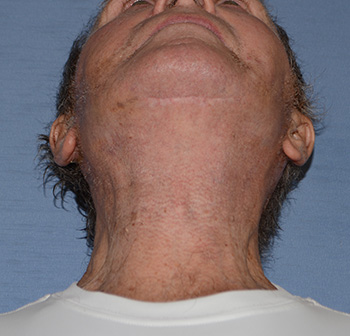 facelift neck lift