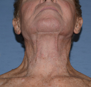 facelift neck lift