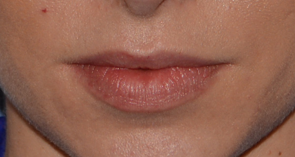 lip fillers