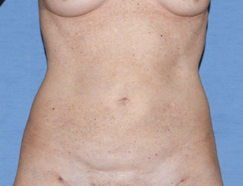 liposuction