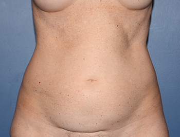 liposuction