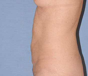 liposuction liposuction