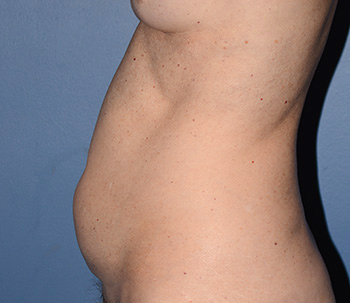 liposuction