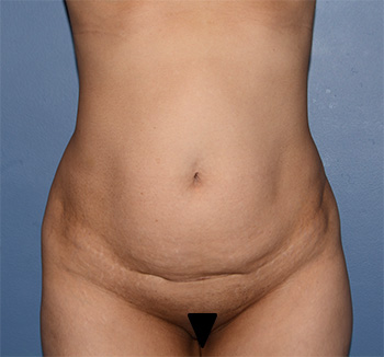 tummy tuck