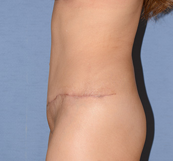 tummy tuck