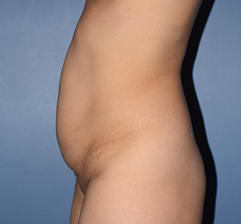 tummy tuck