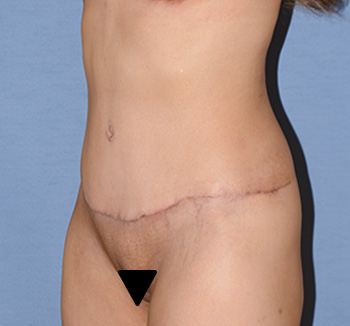 tummy tuck