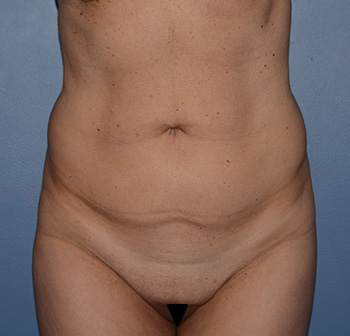 tummy tuck