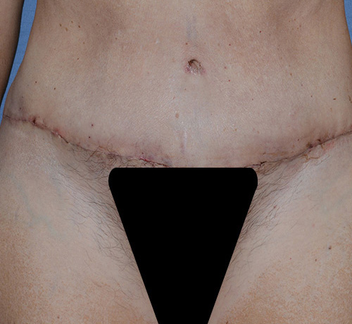 tummy tuck with liposuction