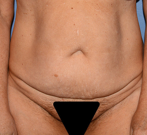 tummy tuck with liposuction
