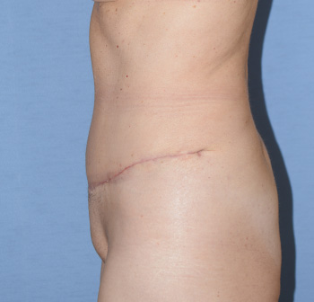 tummy tuck