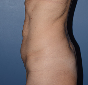 tummy tuck